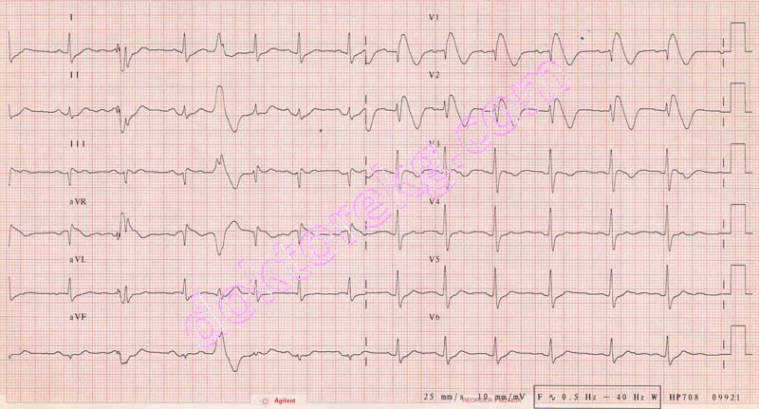 Brugada Sendromu nedir? Tedavisi nasıl yapılır? Belirtileri nelerdir?