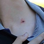 Antalya'da Akran Zorbalığı İddiası: 7. Sınıf Öğrencisi Yaralandı