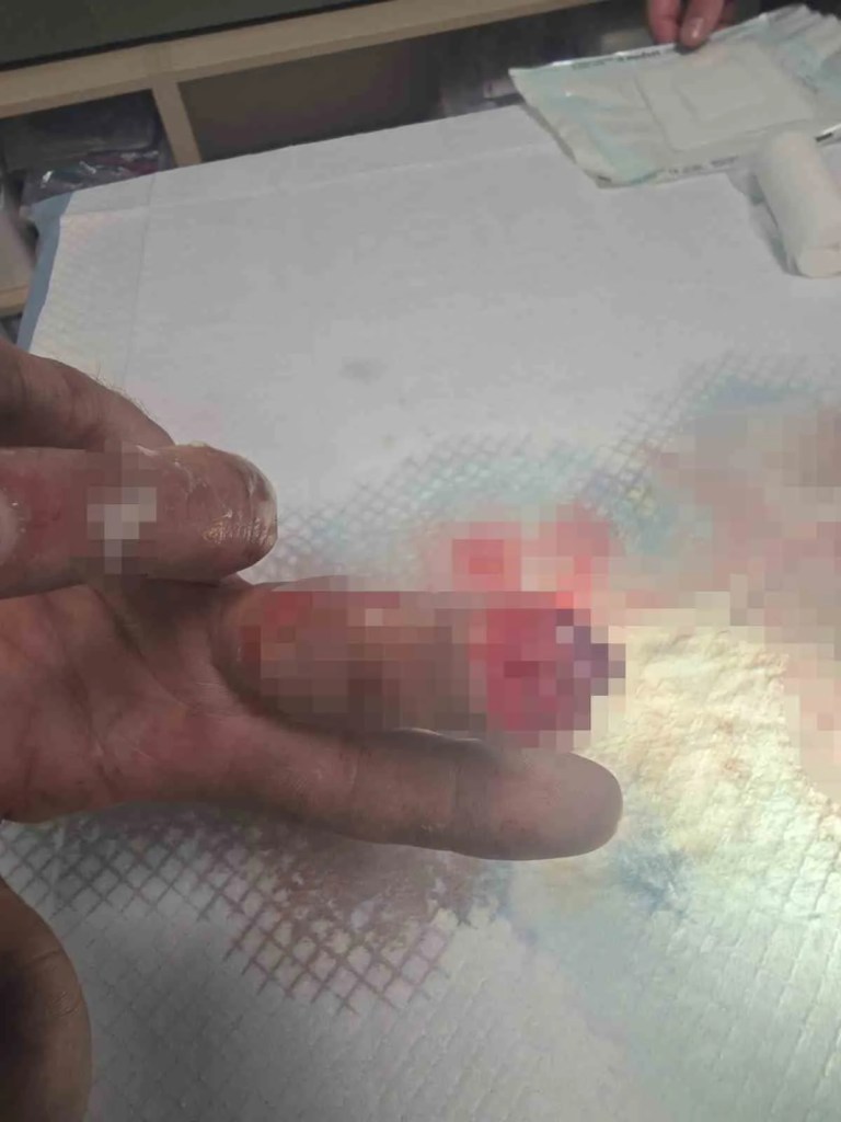 Kopan Parmağını Buz Poşetiyle Türkiye'ye Getirdi