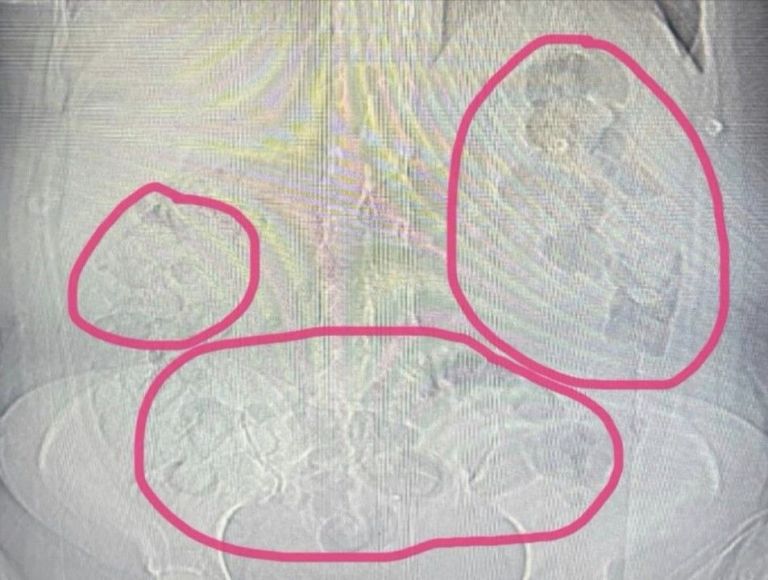 Otobüste yakalandı: Uyuşturucu midesinden çıktı!